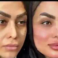 فیلر،بوتاکس چربی مزوتراپی مووپوست پی آرپی پرسینگ