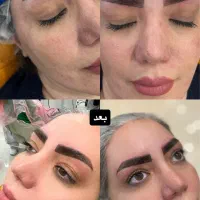 فیبروز/میکروبلیدینگ ابرو