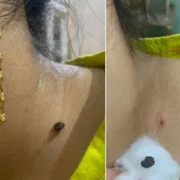از بین بردن زگیل و HPV