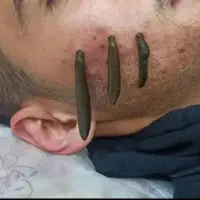 حجامت صورت زالو درمانی جوش صورت بادکش فصد خون
