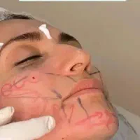 آموزش صفرتاصد ژل و بوتاکس با مدرک