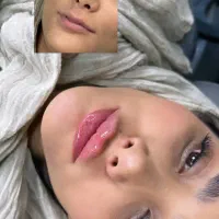 تزریق ژل و بوتاکس از ۷۹۹