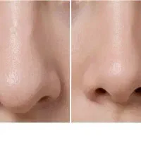 تغییر فرم بینی بدون جراحی