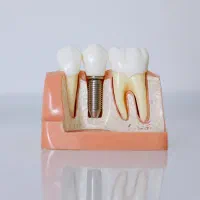 ایمپلنت یک‌روزه، روکش هدیه، شرایط اقساط