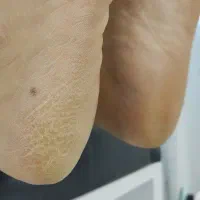 پدیکور خیس حرفه ایی..پدیکور تخصصی..درمان ترک