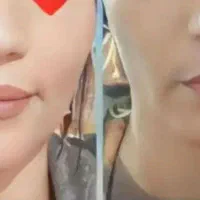 تپلی صورت و بدن قطعیه