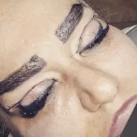 بلفاروپلاستی  لیفت شقیقه دایرکت ابرو  میدفیس