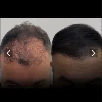 مرکز خدمات حرفه ای اسکالپ(میکروپیگمنتیشن)