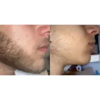 شنیدم ریشات در نمیاد بیا من کمکت کنم در بیاد