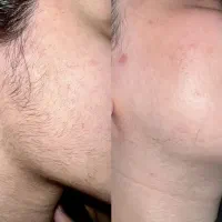 الکترولیز حذف دائمی انواع مو