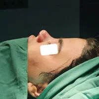 جراحی زیبایی بینی (رینوپلاستی)