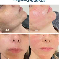 آف تزریق انواع مزوژل توسط شخص پزشک در مطب زیبایی