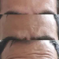 تخفیفات ژل بوتاکس مزو میکرو پی آرپی