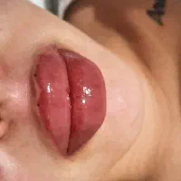 فیلر،آنزیم،بوتاکس،پیرسینگ و میکرودرمال