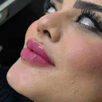 تزریق ژل وبوتاکس درکلینیک