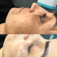 تجربه درخشش پوست /فشیال تخصصی پوست