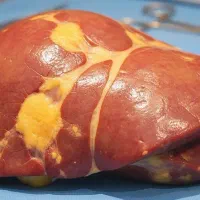 پاکسازی گیاهی کبد چرب