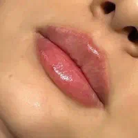تخفیف تزریق فیلر