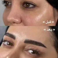 افتادگی پلک  بابخیه لیزری توسط متخصص چشم