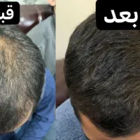 پرپشتی و درمان ریزش