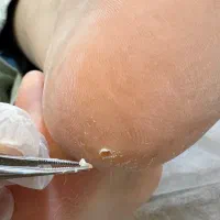 درمان عارضه های پا در مطب پزشک توسط پودولوژیست
