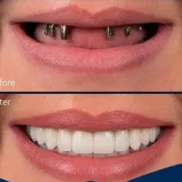 مرکزفوق تخصصی ایمپلنت دیجیتال مشهد/یکروز/کاخ لبخند