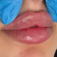 جشنواره فیلربادی  ،بوتاکس زیربغل،فیلرچشم پروفایلو|خدمات زیبایی و سلامت|کرج, گلشهر|دیوار