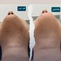 جشنوار لیزر برای زیبا جویان فول بادی فقط 690