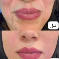ژل سی سی950 و بوتاکس با مواد اصل و تضمینی