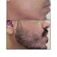 رویش ریش تضمینی