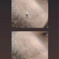 خال‌برداری تخصصی داخل مطب،،قیمت مناسب، نتیجه فوری
