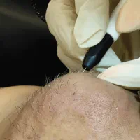 حذف دائمی موهای زائد سفیدوسیاه (الکترولیز)