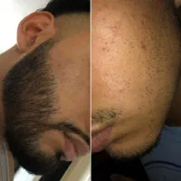 ریش پرپشت، سریعتر از تصور