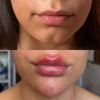 تزریق ژل و بوتاکس با بهترین متد