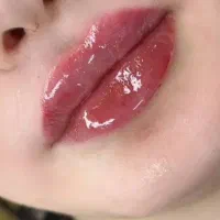 تخفیفات ویژه فیلر و بوتاکس