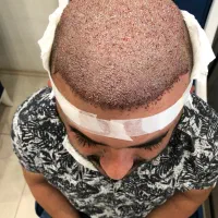 کاشت مو|خدمات آرایشگری و زیبایی|شیراز, قصرالدشت|دیوار