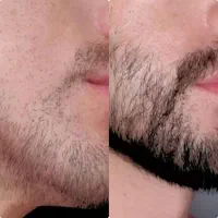 پکیج تخصصی رویش مجدد ریش و سیبیل