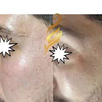 لیزرفرکشنال اربیوم فوتونا جوانساز،جای جوش زخم بخیه