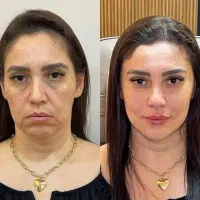 مدل ژل و بوتاکس