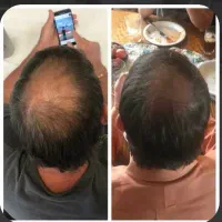 کم پشتی و ریزش موهات بیشتر شده
