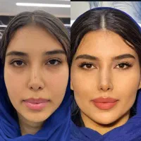 فیلر، مزو، هایفو، فیشیال،