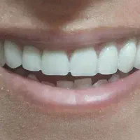دندان مصنوعی با ضمانت ۱۰ ساله