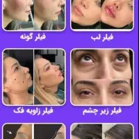 اف ویژه انواع فیلر های کره ای صورت