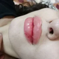 تزریق زل بوتاکس و انزیم