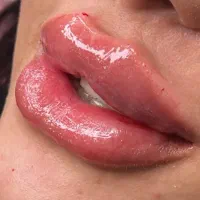 تزریق ژل ـ فیلر لب