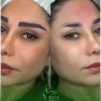 کاشت ابرو ، میکرو کاشت ، جشنواره