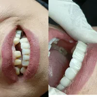 روکش دندون