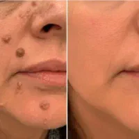 آف ویژه حذف خال،لک،ککومک پوستی و تتو ابرو