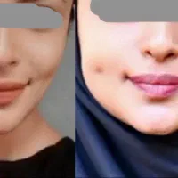 چیکار کنم صورتم توپول بشه