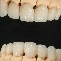 قالب ریز و پیک دندان سازی
